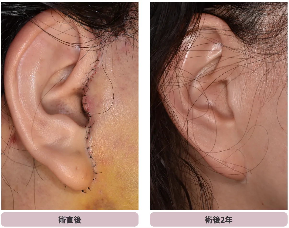 フェイスリフト傷跡の画像