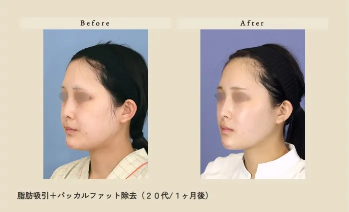 フェイスリフト症例