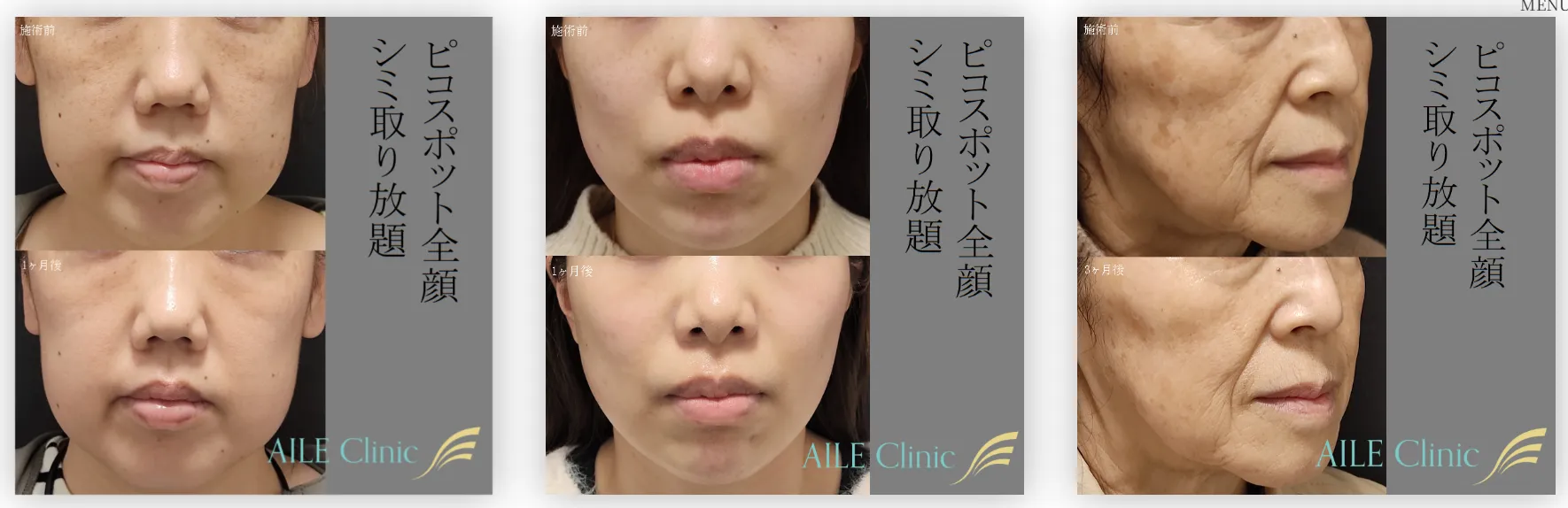 ピコスポットの症例写真