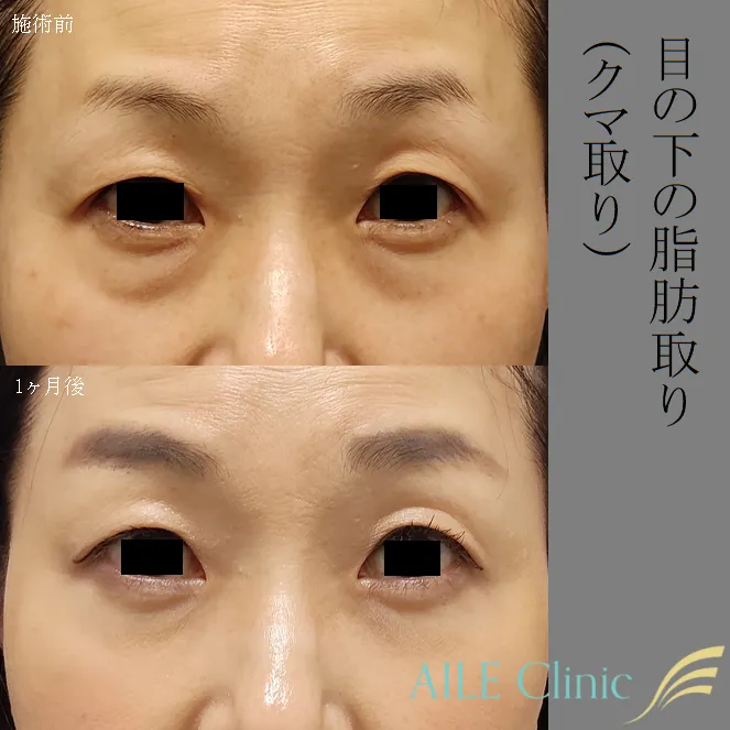 目の下の脂肪取り症例