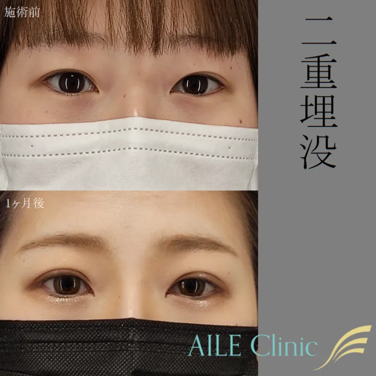 二重埋没法症例