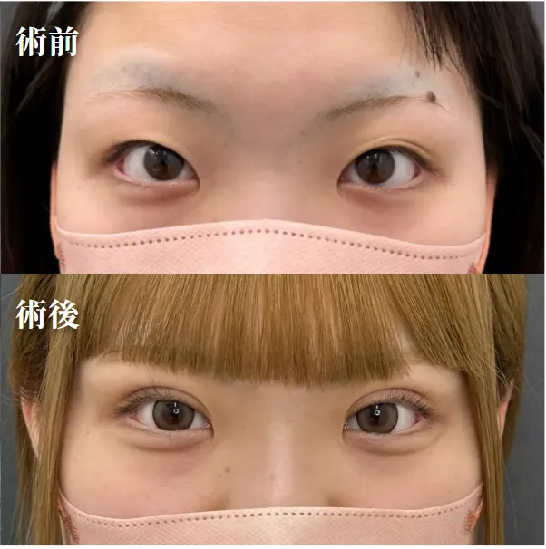 二重埋没症例写真