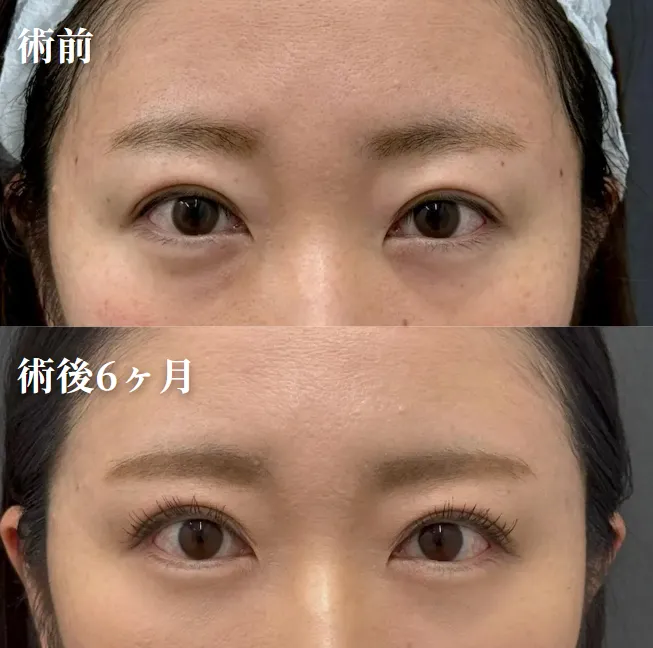 クマ取り症例写真