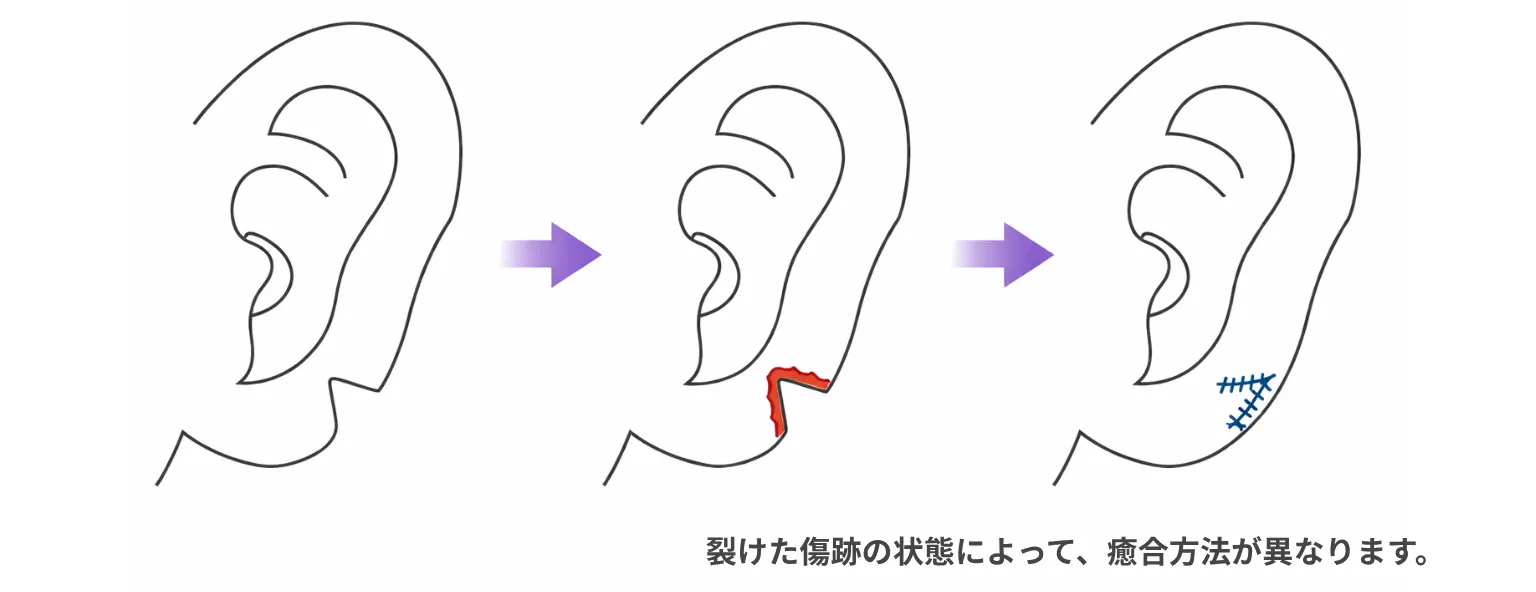 裂けた耳たぶの修正方法解説