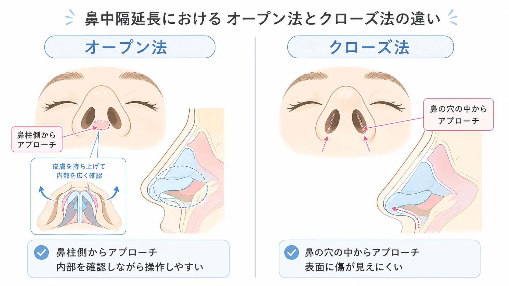 オープン法とクローズ法の比較