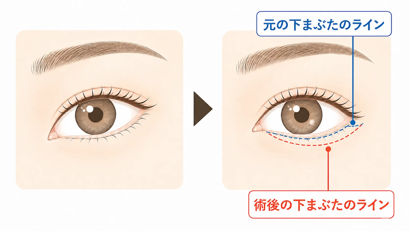 グラマラスラインの施術方法