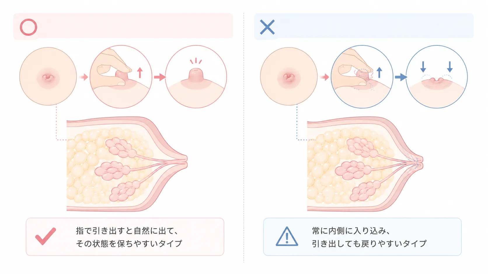 陥没乳頭のグレード1から3の違い