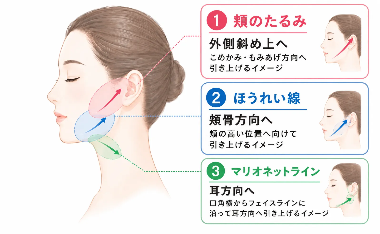 糸リフト部位別の糸を入れる角度解説画像