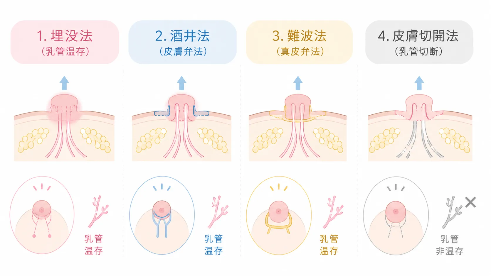 陥没乳頭手術方法