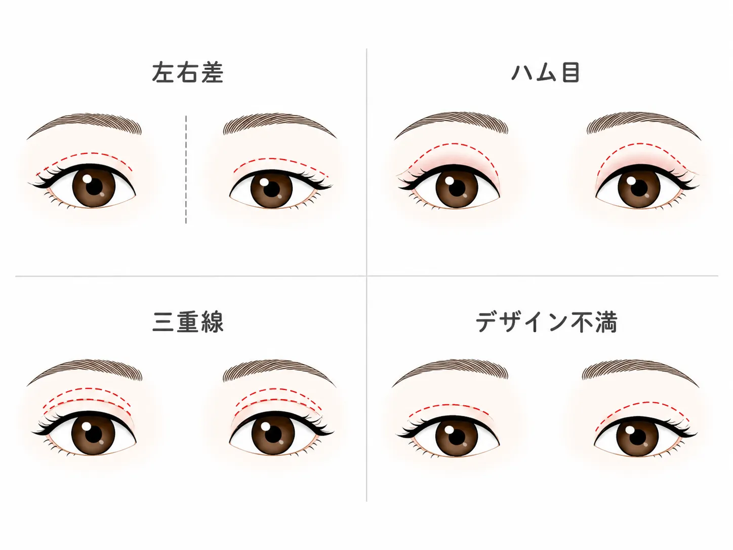 埋没法の失敗例イラスト