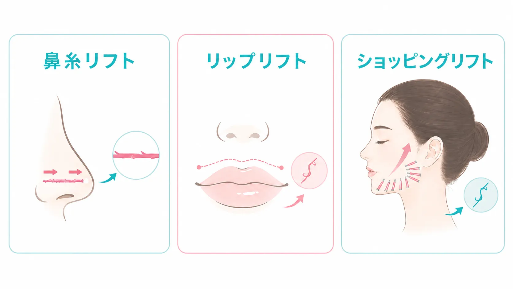 鼻糸リフト、リップリフト、ショッピングリフトのイラスト