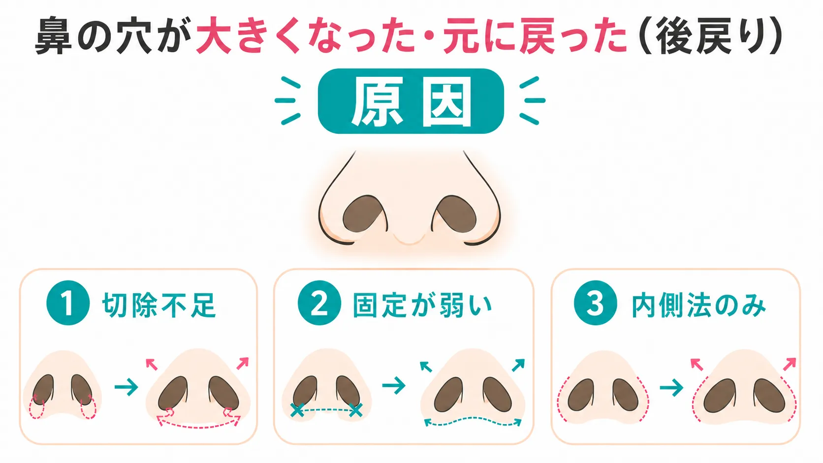 小鼻縮小修正│鼻の穴が大きくなった状態の症状と原因イラスト