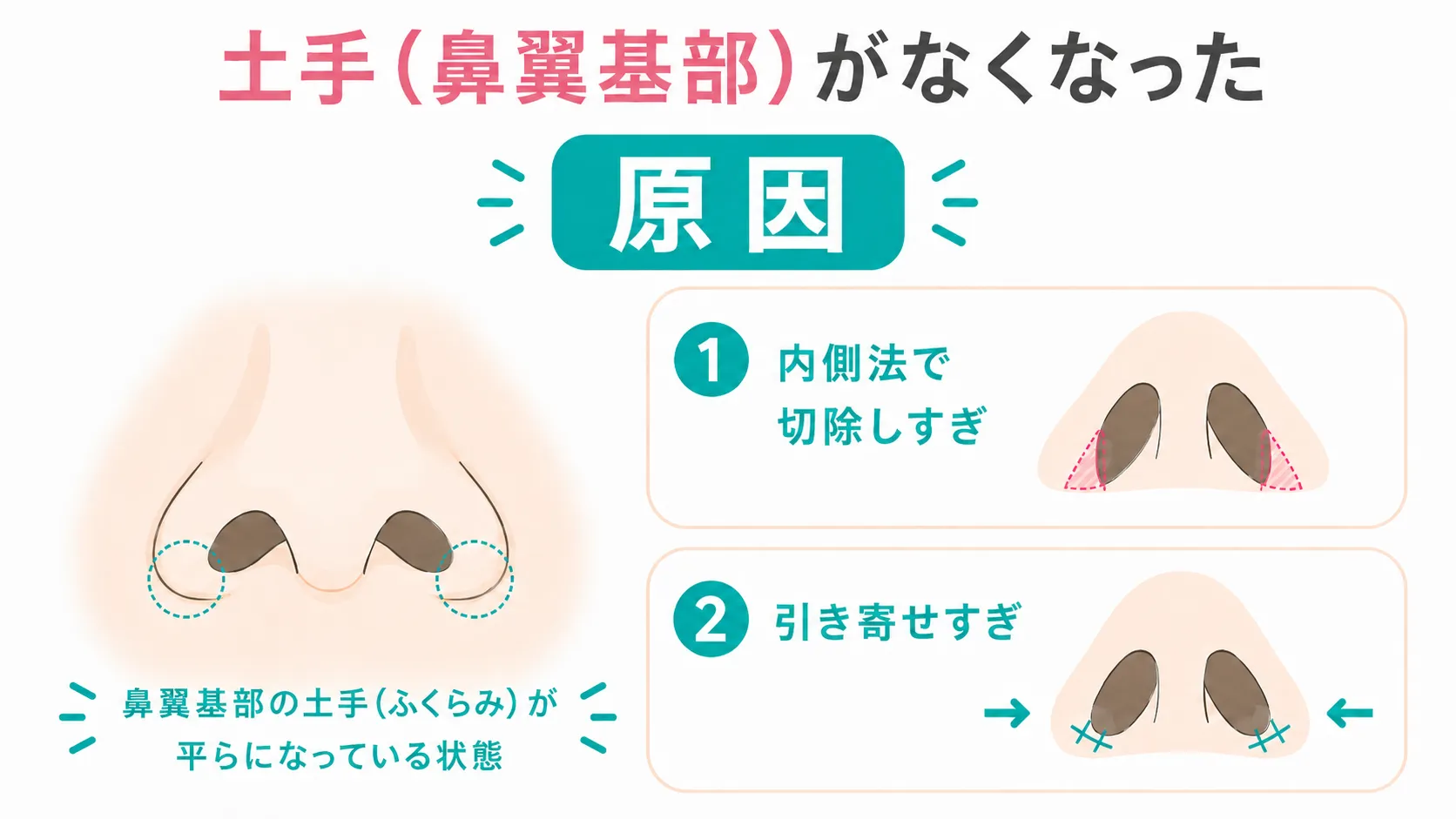 小鼻縮小修正│土手がなくなった状態の症状と原因イラスト
