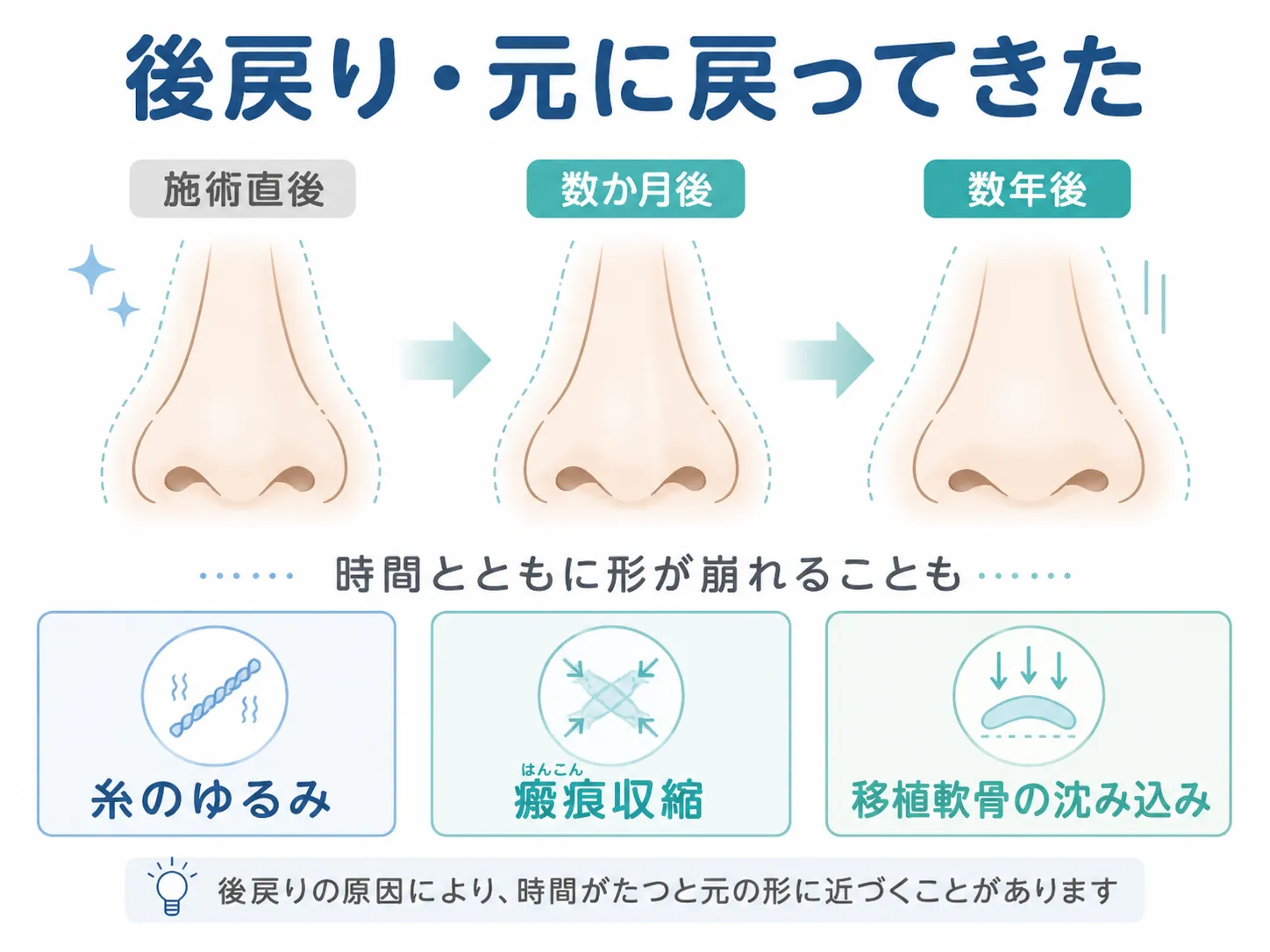 鼻尖形成の修正│状態のイラスト(後戻り・元に戻ってきた)